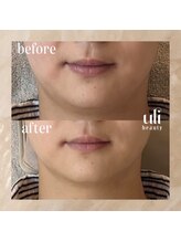 ウリ(uli beauty)/比較写真