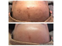 ベビースキン(baby skin)/肌改善