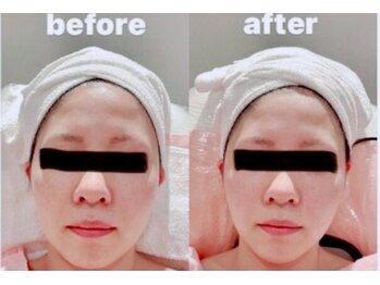 スイープジュニパー 東浦(sweep juniper)/インディバフェイシャル