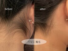 ビジュー(bjyou)/うなじ脱毛