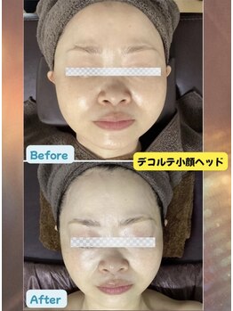 チャルメ/デコルテ小顔ヘッド【1回】