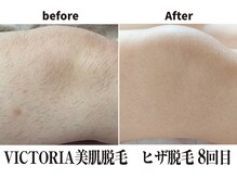 マイン イオンモール浜松市野店/速くて痛みが少ない美肌脱毛！
