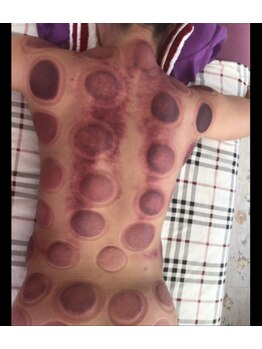 東洋経絡エステ アンド リラクゼーション/カッピングによる嬉い効果★