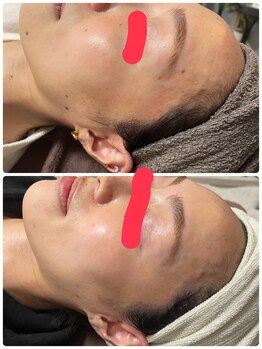 ビューティーホームサロン(Beauty Home Salon)/シミケア　顔全体