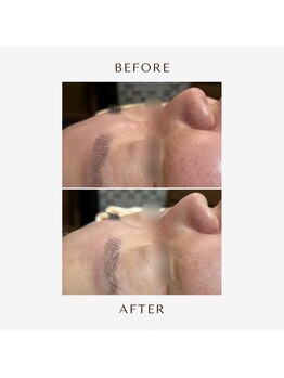 ヒヨリ(hiyori)/《before/after》毛穴洗浄