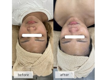 ヴィーナス(Venus)/ヒト幹細胞×美肌菌ピーリング