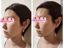 シェノン(Chainon)/セラピール1回でたるみも改善！