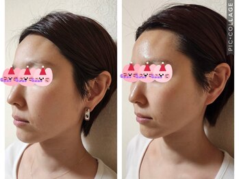 シェノン(Chainon)/【セラピール1回】たるみ改善!