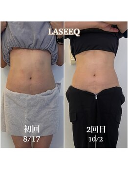 ラシーク(LASEEQ)/お腹の脂肪冷却2回目のお客様