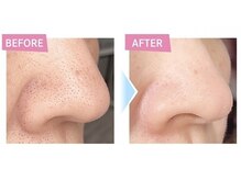 デジール/【メンズハイドロ毛穴洗浄吸引】