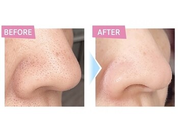 デジール/【メンズハイドロ毛穴洗浄吸引】