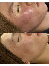 レイ(Lei)/最速で改善するならハーブリプロ