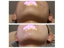 ベビースキン(baby skin)/肌改善