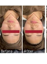 ブーラン(BULAN)/脂肪分解　小顔