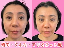 ナチュラルパーフェクトフェイス 新宿/新宿小顔矯正/渋谷区/造顔小顔