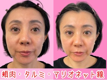 ナチュラルパーフェクトフェイス 新宿/新宿小顔矯正/渋谷区/造顔小顔