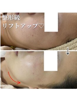 セリー(Celie)の写真/【もう隠さない】年々気になるほうれい線・たるみにアプローチ！素肌からピンと張る若々しく元気なお肌に