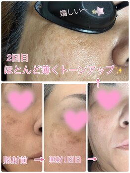 エシャーム(echarme)/Eライト　シミ改善・くすみ改善