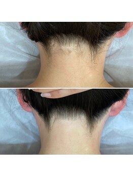 インベスト(INVEST)/うなじ脱毛