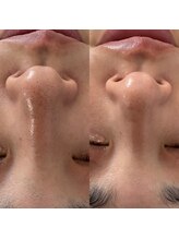 モア 吉祥寺(MORE.)/毛穴洗浄Before after