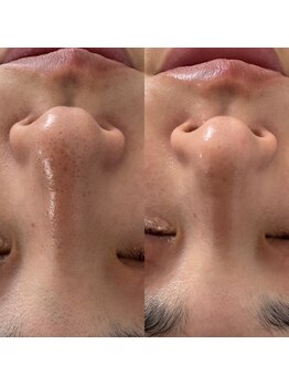 モア 吉祥寺(MORE.)/毛穴洗浄Before after