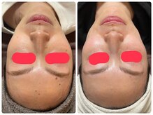 ビューティーホームサロン(Beauty Home Salon)/シミケア　顔全体