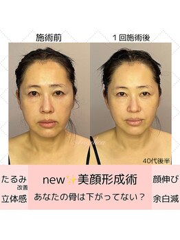 アンジェリカ(Angelica)/美顔形成術★STOP！顔の雪崩