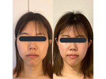 ハイコガオ(HIKOGAO)/小顔矯正40分