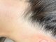 アンドミー(&me)の写真/意外と見られているうなじ部分の脱毛メニュー！アップスタイルやショートヘアの後ろ姿をさらに美しく♪