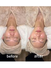 イリジアエリート(inizia elite)/小顔コルギ