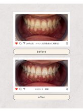 スマイルプライベートビューティサロン(Smile)/セルフホワイトニング
