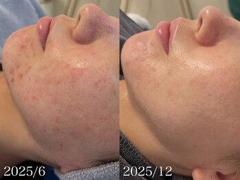 リリアス(RILLIAS)/ニキビケア