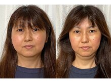 美容整体 アルマ/輪郭改善15回