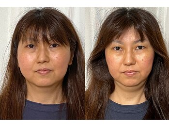 美容整体 アルマ/輪郭改善15回