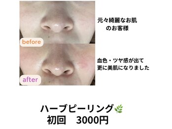 サクラ(SAKURA)/ハーブピーリングで艶肌♪
