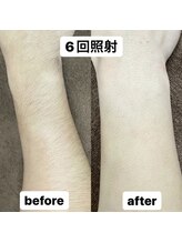 ココ(Coco)/うで脱毛