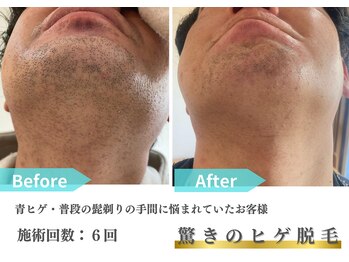 トレース/ヒゲ脱毛の効果