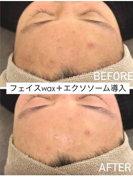 ネオファースト 大阪福島店(NeoFirst)の写真/【憧れの韓国ツヤ肌に♪】スキンケアの浸透率も格段にUP《艶肌フェイスワックス＆エレクトロポレーション》