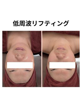 ワイズ(Y's)/低周波リフティング