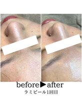 シェリール(cherir)/毛穴にも◎ラミピール