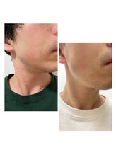 ナチュールムーン(Nature moon.)/男性　顔脱毛