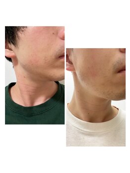 ナチュールムーン(Nature moon.)/男性　顔脱毛