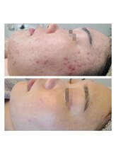 リンド(Lindo)/ハーブトリートメント