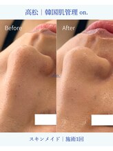 オン(on.)/【毛穴】施術一回での変化です♪