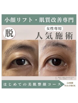 整顔院 経堂店の写真/目元のたるみ改善クマやくすみ解消！老け顔・疲れ顔にサヨナラ◎若々しい印象へ♪