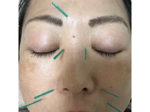 一二三鍼灸マッサージ治療院/【花粉による不調☆お顔の施術】