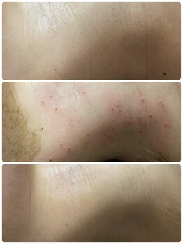 ビューティーホームサロン(Beauty Home Salon)/シミケア　首周り当て放題