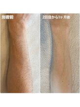ビテラス/パーツ毎の脱毛もOKです◎