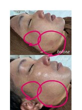 キュル(Kyul)/REVIハーブピーリング