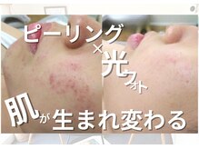 キザシ(kizashi)の雰囲気（ピーリング＆光フォトでお肌を深層から持ち上げる☆）